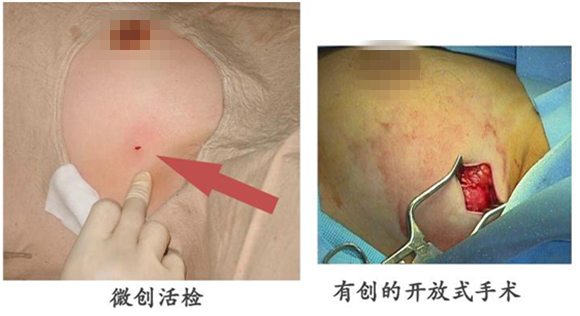 单县东大医院手术新篇章:微创切除乳腺良性病变